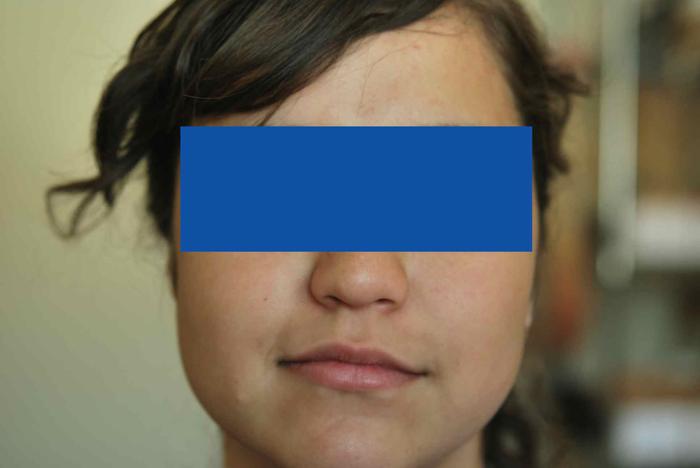 Prótesis para microtia